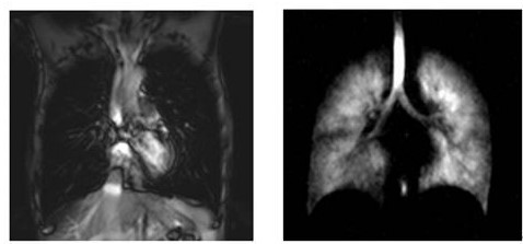 传统肺部磁共振图像与被点亮后的肺部磁共振图像对比图片